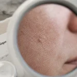 Kératose visage : plaque rugueuse actinique sur peau du visage